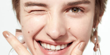 5 Tips for Reducing Acne or Breakouts